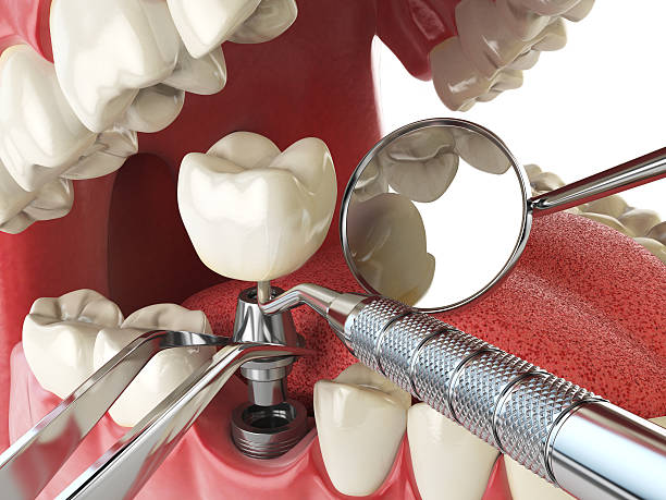 Best Knocked-Out Tooth (Avulsed Tooth) Treatment in Southmont, PA